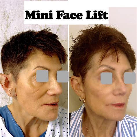 mini face lifts near me 9