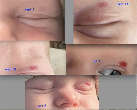 Stork Bite Eyelid