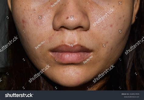 acne dark spots scars  face stock photo  shutterstock