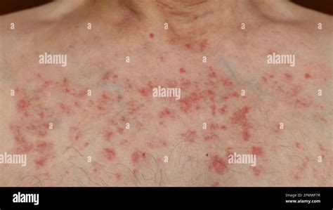 chest rash