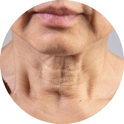 Neck Lines: Causes and Treatment