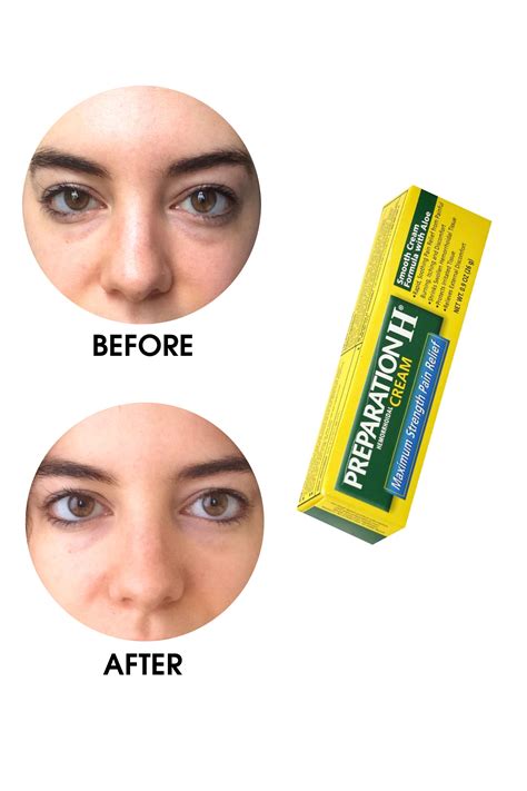 Eye Bags Treatment Australia at Luca Glossop blog