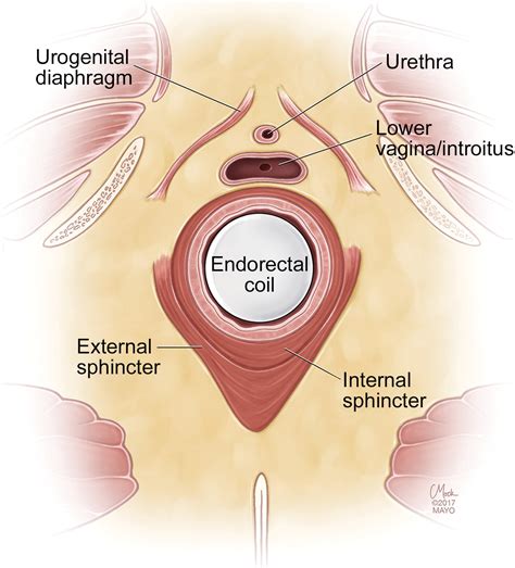 Imaging and Surgical Management of Anorectal Vaginal Fistulas