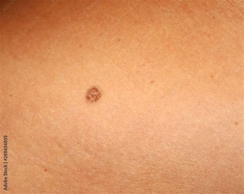 brown spots   skin spot dark stock photo adobe stock