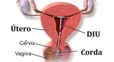 Como É Colocado O Diu Mirena - DIU Mirena: O que é? Saiba tudo sobre esse método!