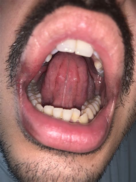 White patches under tongue : AskDocs