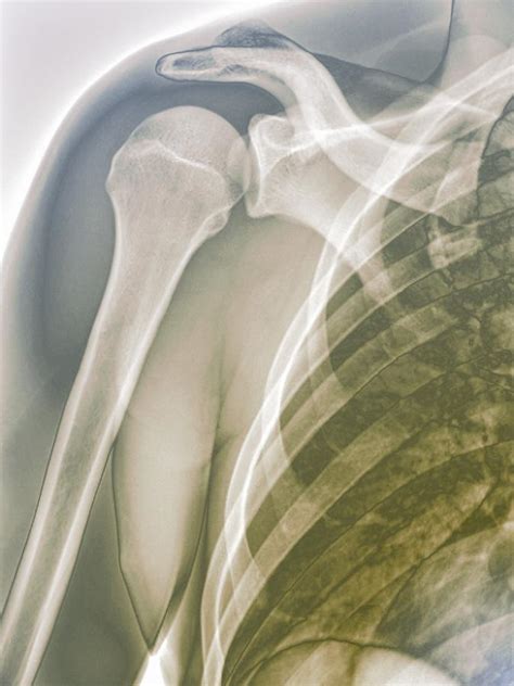 Normal Shoulder, X-ray Photograph by Zephyr | Fine Art America