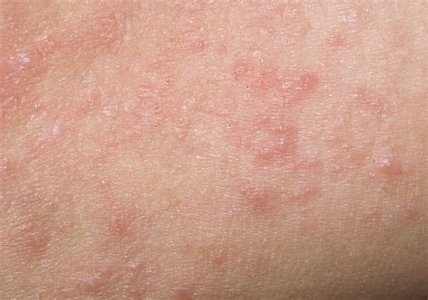 Hepatitis C Symptoms Itching