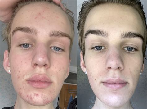 acne treatment  teenage boys mdacne