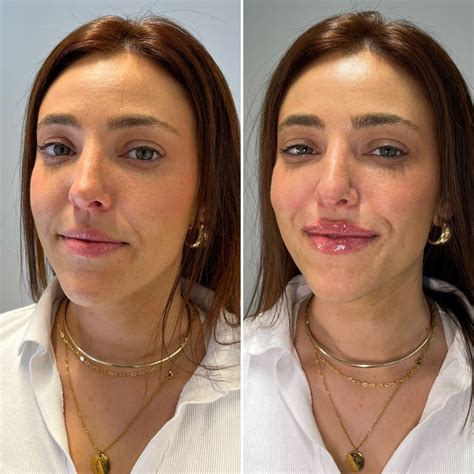 natural  lip filler transformation
