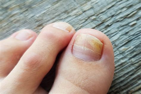 Toenail Fungus Treatment | Podiatric Solutions for Onychomycosis