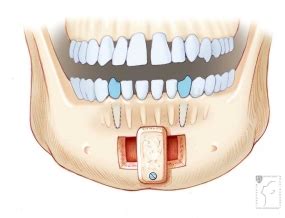 genioglossus advancement stanford health care
