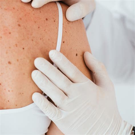 Mohs Surgeon in Kent Island - Cronin Dermatology