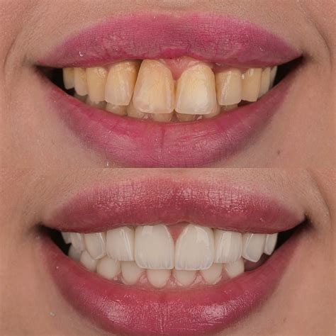 Veneers – IVORY CLINICS