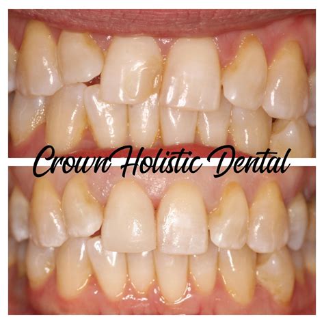 Crown - Dr.Tisa Transforms Your Smile with Anterior Restorations! Your