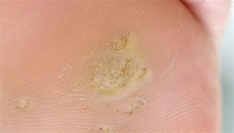 weird skin holes