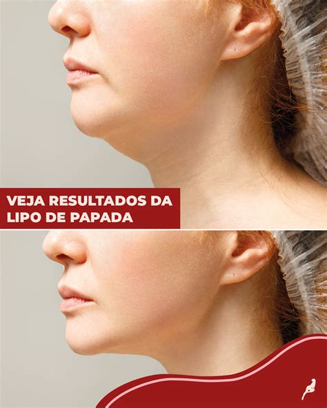 Qual O Valor De Uma Lipo De Papada
