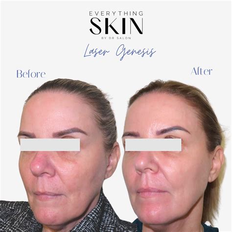 laser genesis perth laser treatments  skin  dr salon