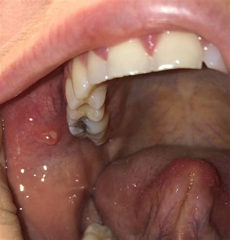 raised bump   cheek mildly uncomfortable