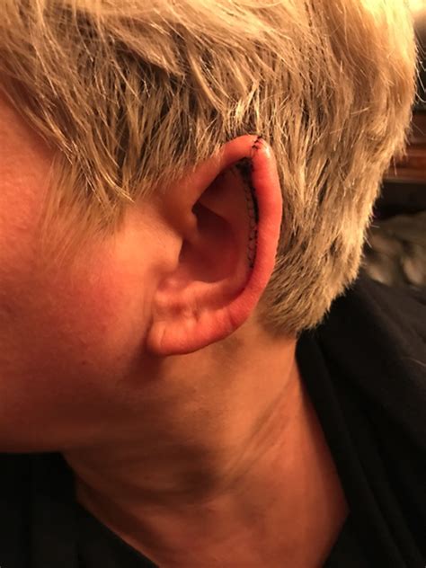 What Do Railroad Track Ears Look Like at Anita Sosebee blog
