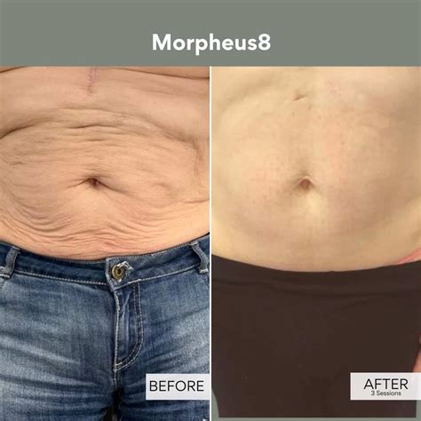 Morpheus8 Before & Afters | Morpheus8 Results | Vie Aesthetics