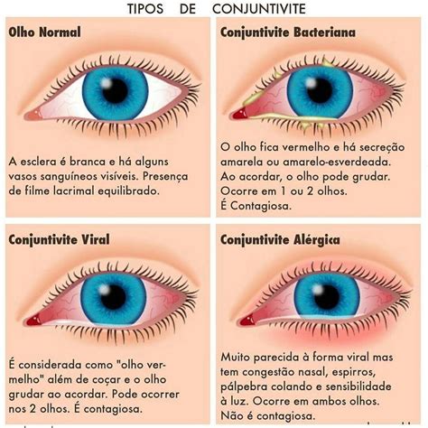 Cid X Conjuntivite Viral - Conjuntivite viral: causas, fatores de risco, tratamento e prevenção ...