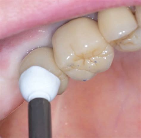 Digital Impression of Two Scannable Temporary Abutments and the