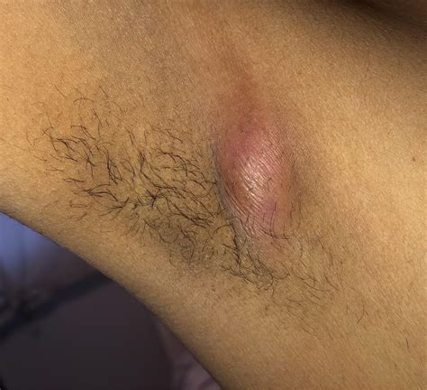 A pea-sized bump appeared on my armpit around 5 days back. Now it has