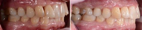 Фото зубів до і після встановлення елайнерів | Soloaligners