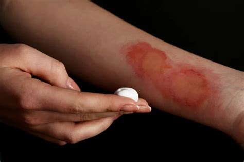 Skin burn Stock Photos, Royalty Free Skin burn Images | Depositphotos
