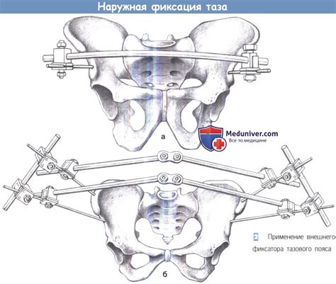 Этапы и техника наружной фиксации таза