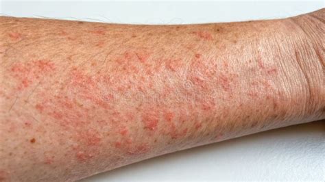 Eczema Skin Rash Red Arm Closeup Irritation Atopic Dermatitis Flare ...