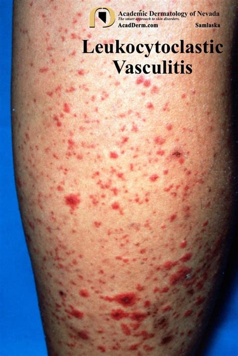 Leukocytoclastic Vasculitis: Small-Vessel Vasculitis... - Academic Dermatology of Nevada