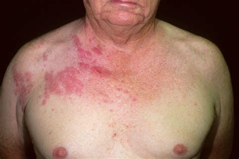 Shingles - Causes, Symptoms, Home Remedies, Treatment