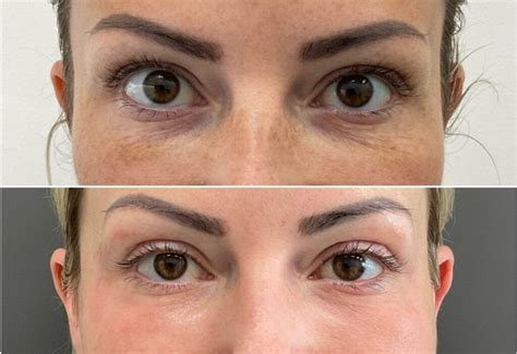 laser resurfacing   oakville  nurse jacklyn
