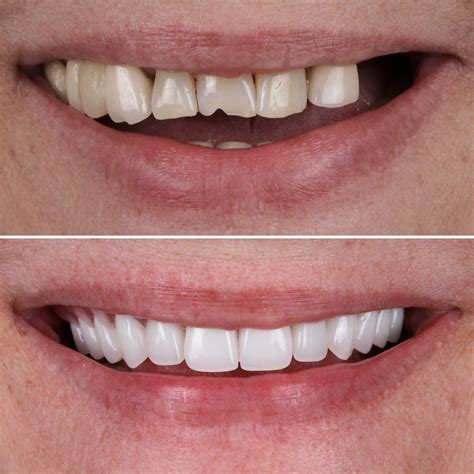 Digital Denture Solutions for Missing Teeth — Clean Teeth Dental