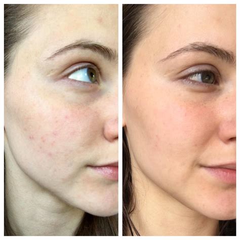 Glycolic Acid Before And After Photos