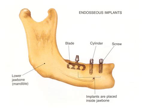 Types of Dental Implants by Sizes, Procedures and Materials