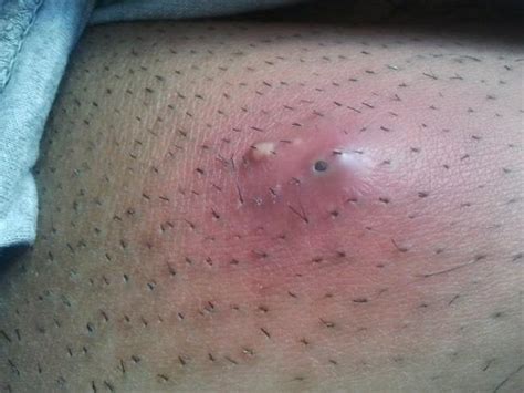 abscess types  symptoms  treatment