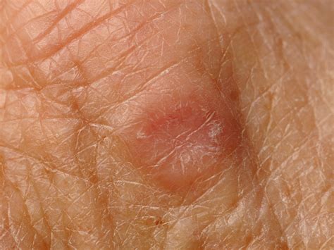 Granuloma Anular Generalizado Da Face