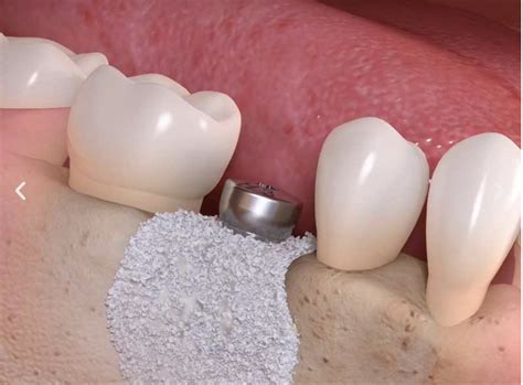 dental bone graft source  cynthia heather blog