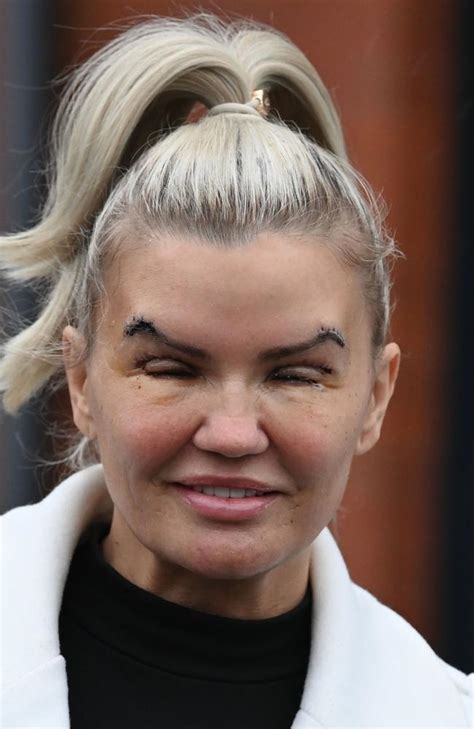 Jaw-dropping photos of Atomic Kitten star Kerry Katona post-eyelift
