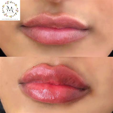 realistic ml lip filler    thin lips transforming