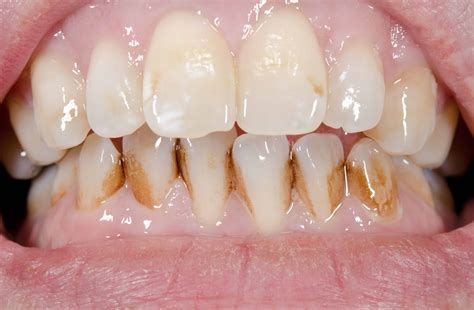 how to get rid of white spots on teeth 4