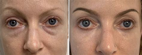 dark bags  eyes treatment
