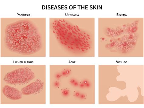 inflammatory skin disorders nutritional therapist tavistock devon
