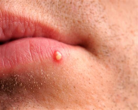 pustules     treatment options prevention tips