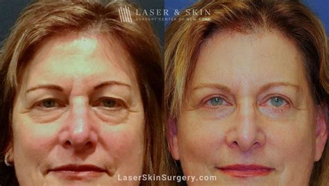 eye bags  york ny laser center