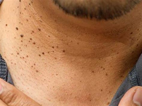 What Causes Skin Tags?