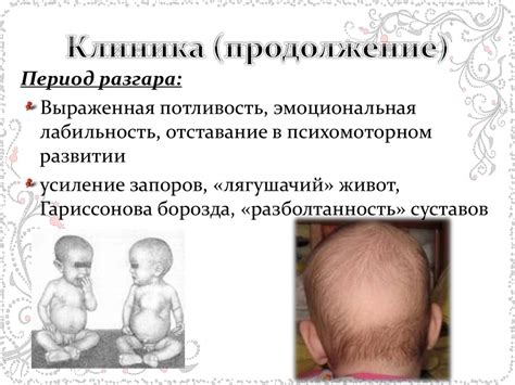 Рахит у детей - презентация онлайн